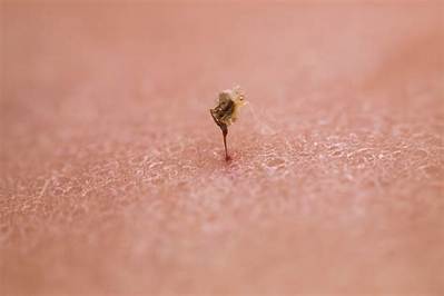 What Draws a Stinger out of Skin?