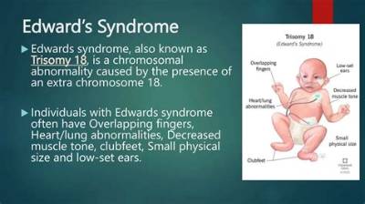 What Gender Does Edwards Syndrome Affect?