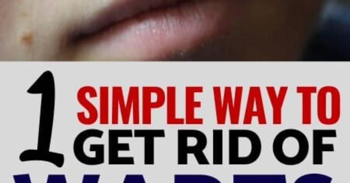 What Gets Rid of Warts Naturally?