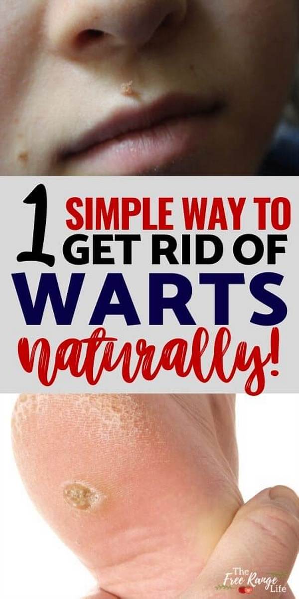 What Gets Rid of Warts Naturally?