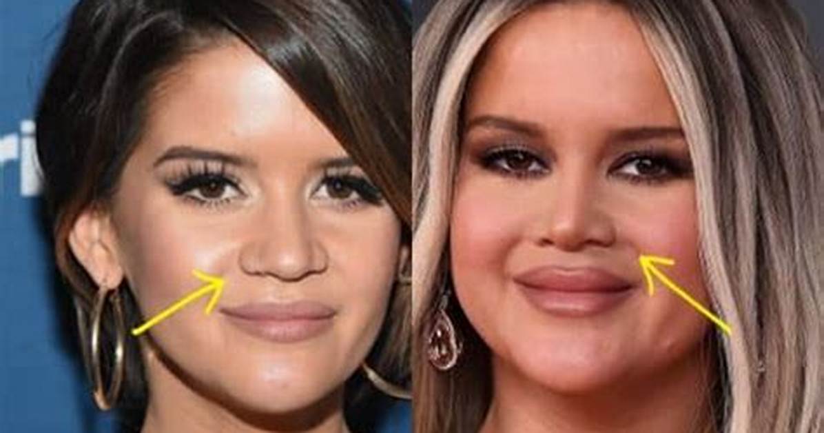 What Happened to Maren Morris Lips? Plastic Surgery Update, Before & After Photos from Instagram