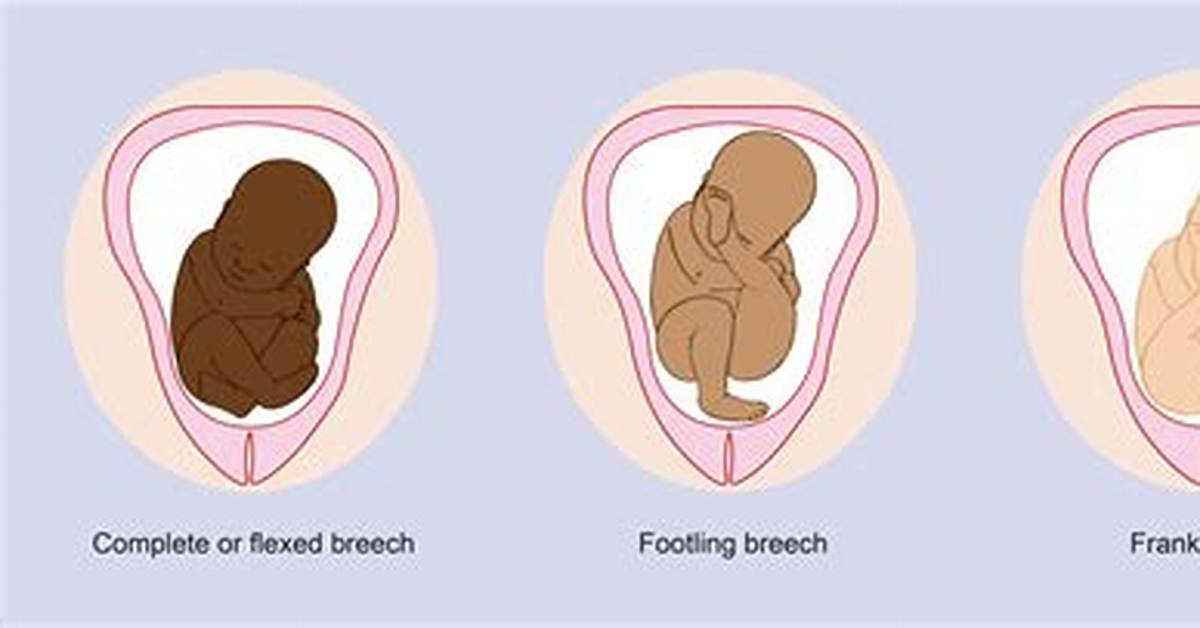 What Happens When a Baby Is Breech?