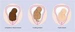 What Happens When a Baby Is Breech?