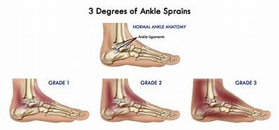 What Is a 3Rd Degree Sprain?