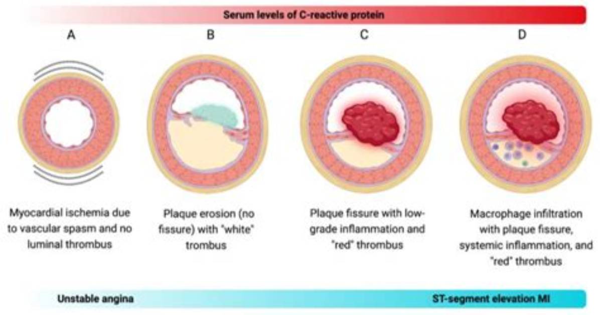 What Is a C Reactive Protein?