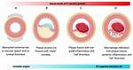 What Is a C Reactive Protein?