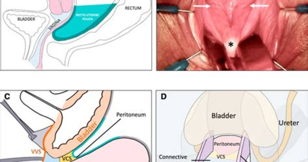 What Is a Colpotomy Ring Used For