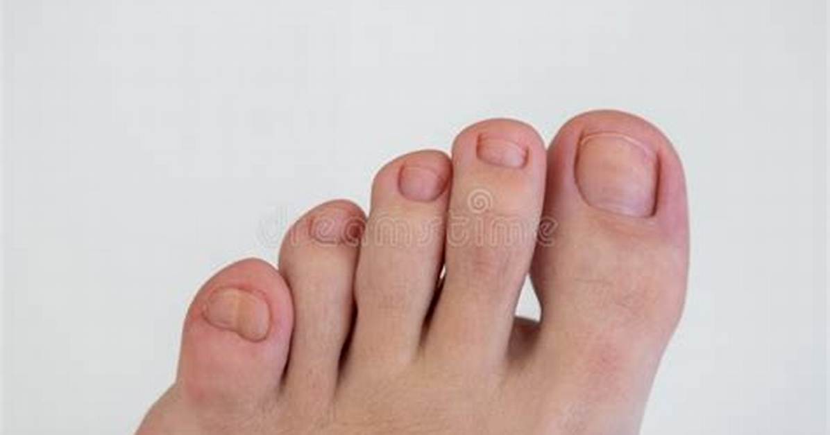 What Is a Double Toenail?