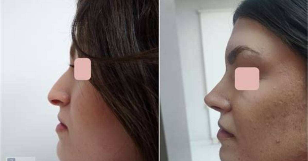 What Is a Droopy Nose?