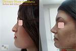 What Is a Droopy Nose?