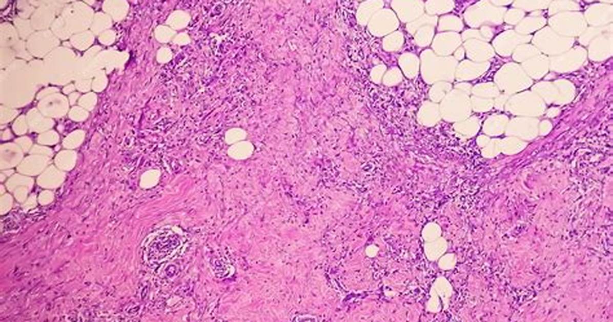 What Is a Granuloma?