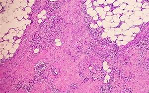 What Is a Granuloma?