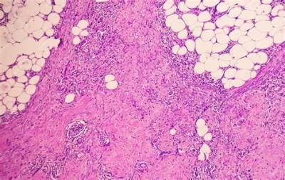 What Is a Granuloma?