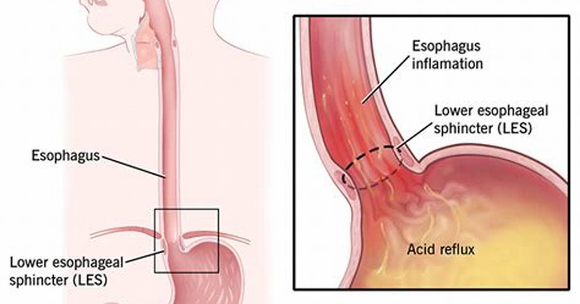 What Is a Reflux