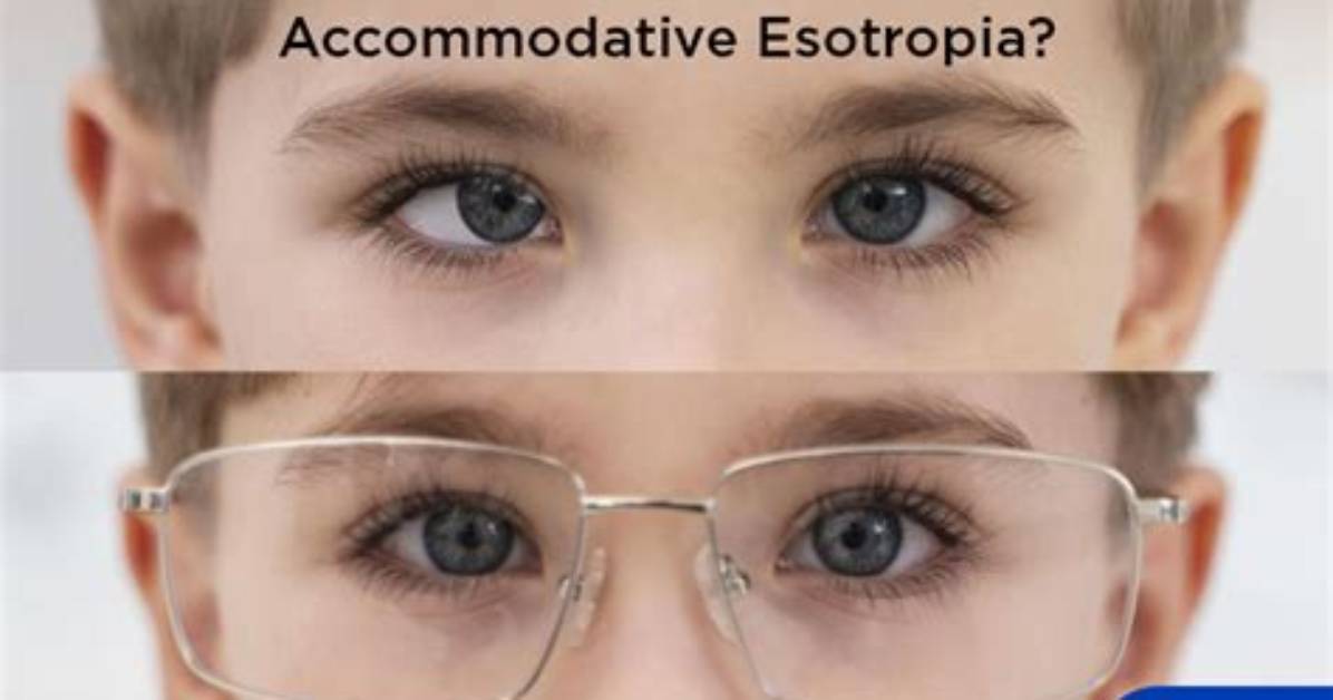 What Is Accommodative Esotropia?