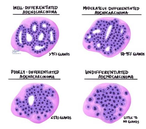 What Is an Adenocarcinoma?