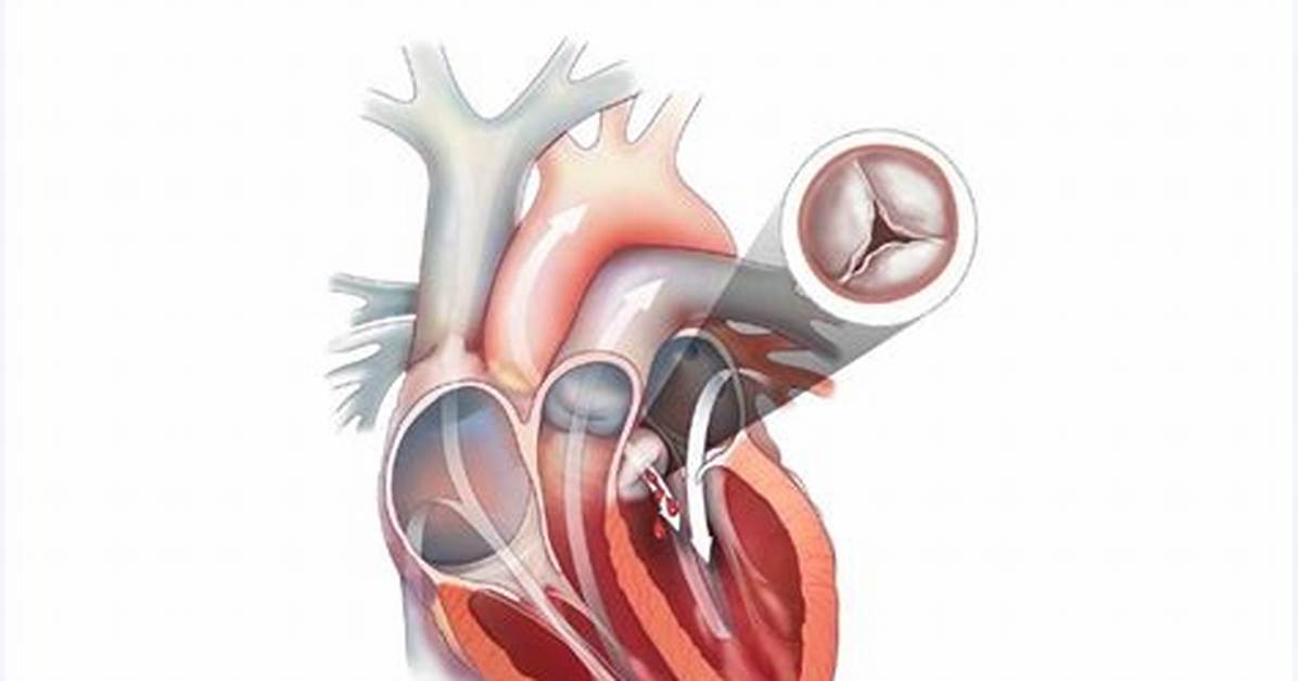 What Is Ar in Heart Disease?