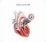 What Is Ar in Heart Disease?