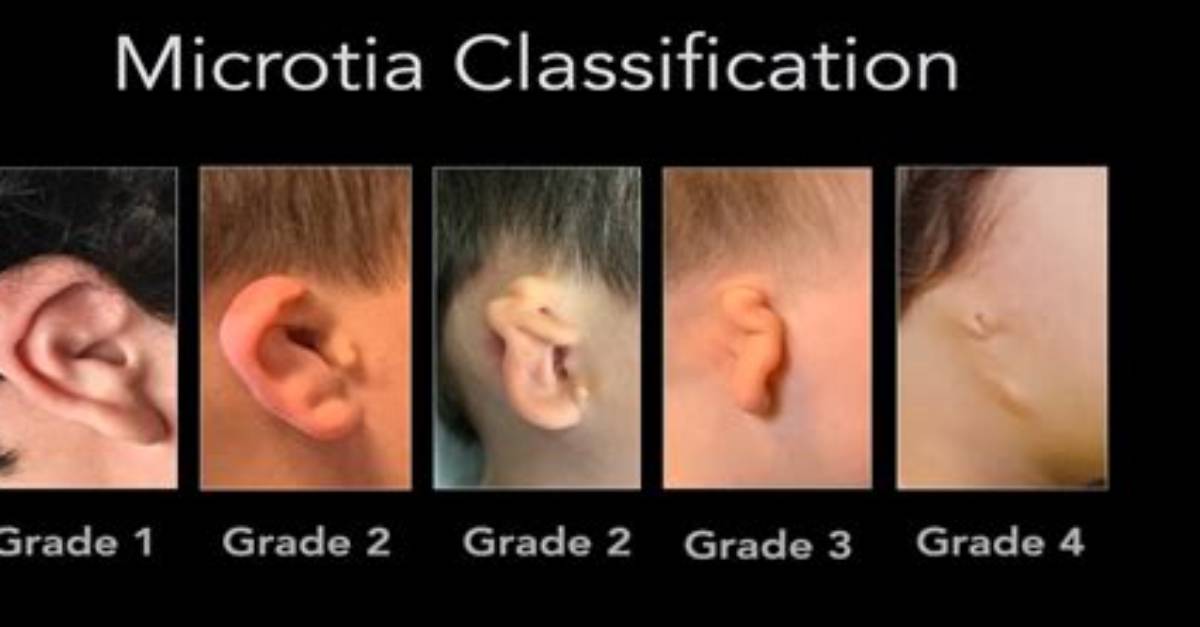 What Is Bilateral Microtia?