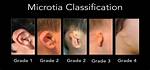What Is Bilateral Microtia?