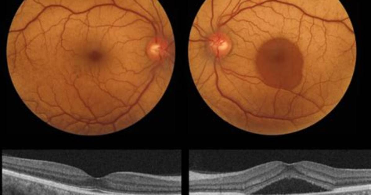 What Is Central Serous Retinopathy?
