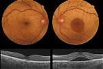 What Is Central Serous Retinopathy?