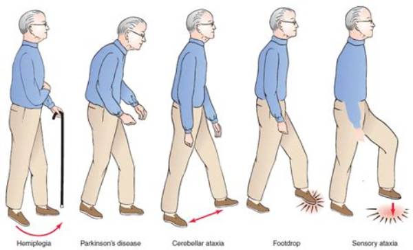 What Is Gait Apraxia?