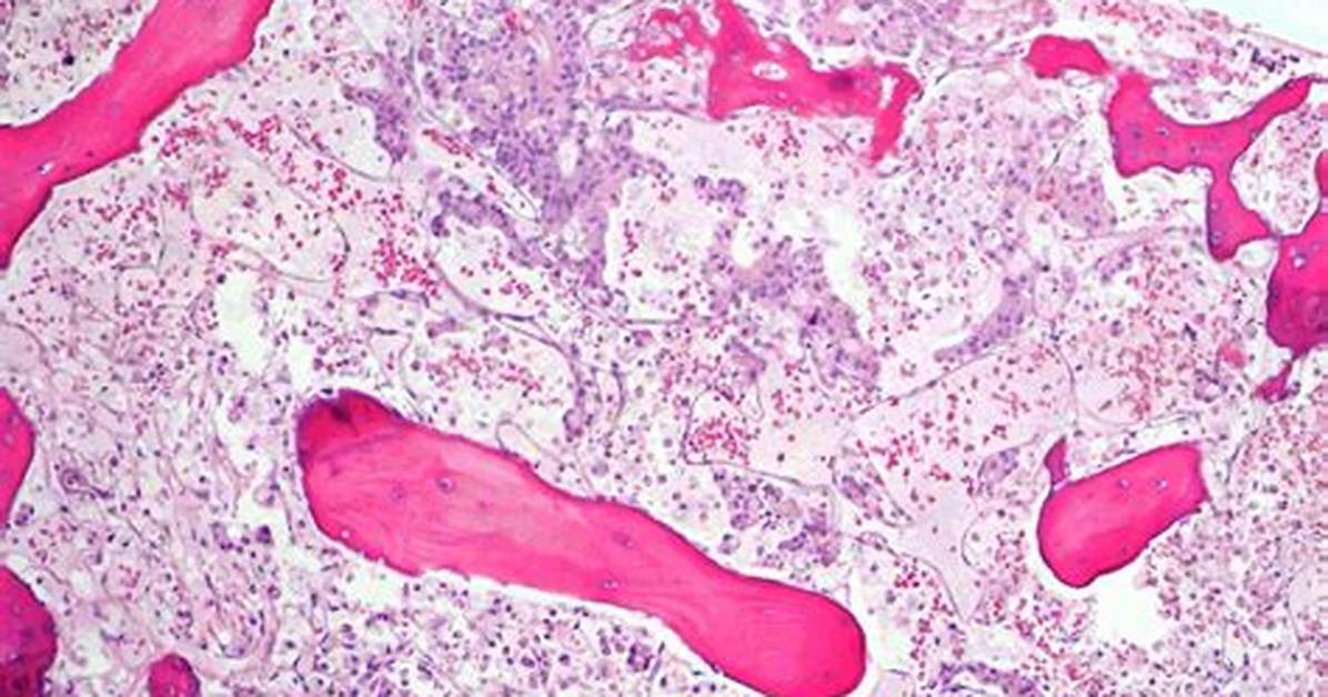 What Is Hypoplasia of Bone Marrow?