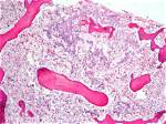 What Is Hypoplasia of Bone Marrow?