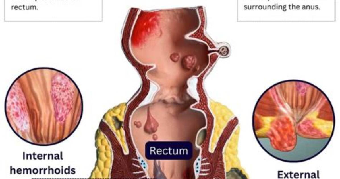 What Is Inside a Hemorrhoid?
