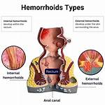 What Is Inside a Hemorrhoid?