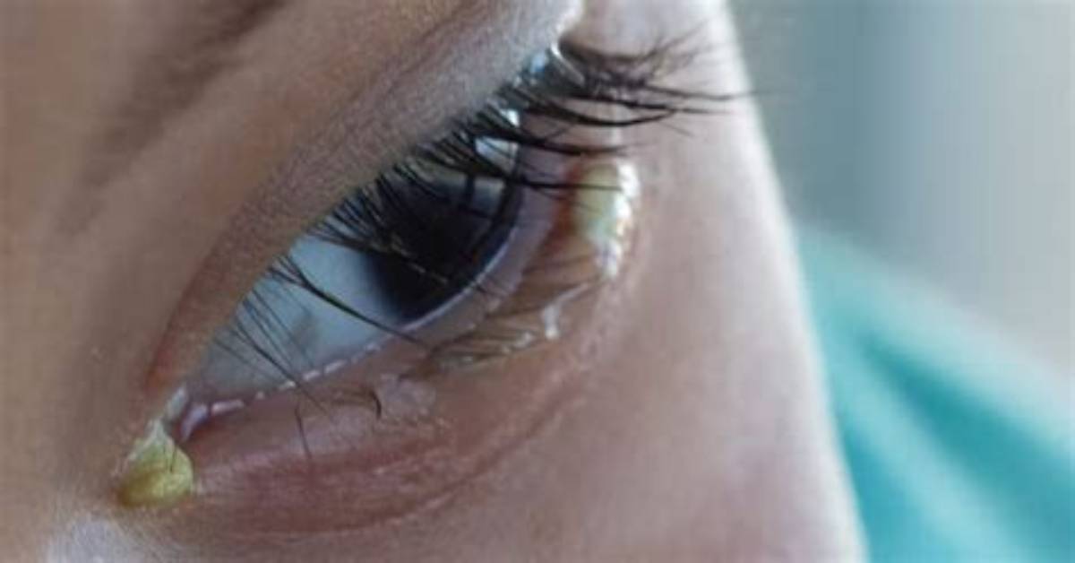 What Is Mattering of Eyes?