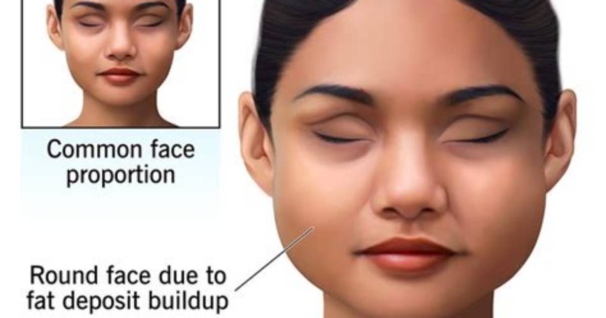 What Is Moon Face Look Like?