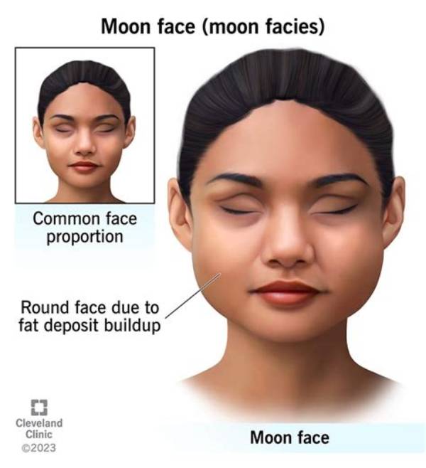 What Is Moon Face Look Like?