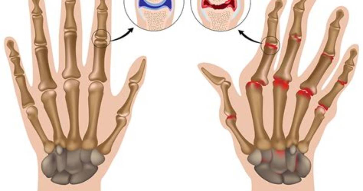 What Is Rheumatoid Aortitis?