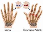 What Is Rheumatoid Aortitis?
