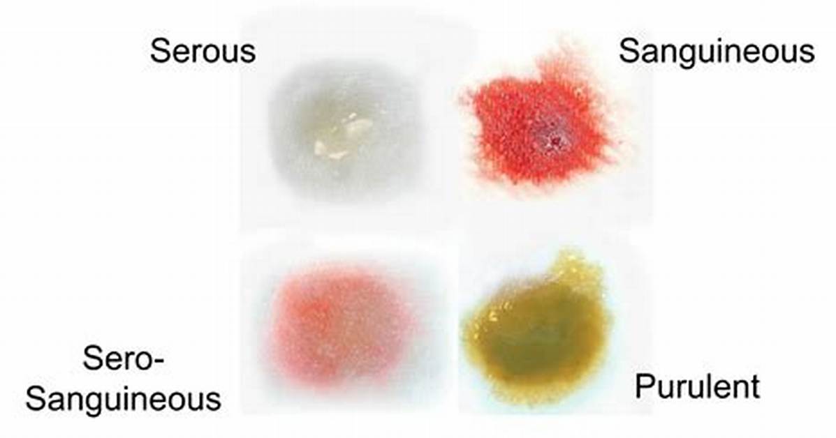 What Is Serosanguineous Exudate?