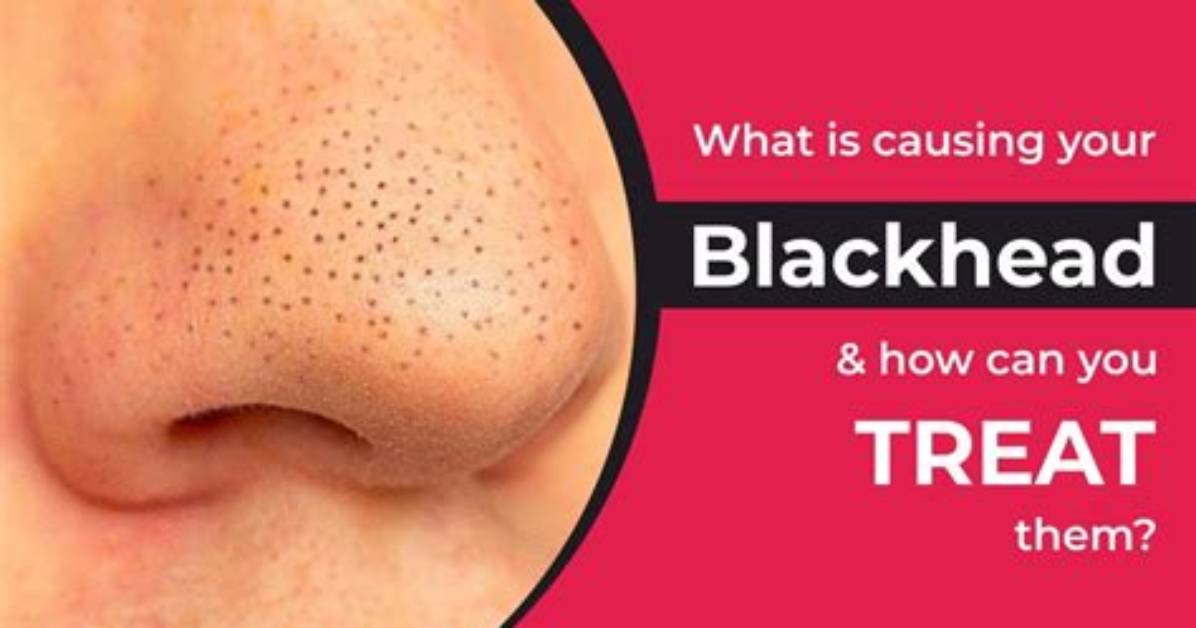 What Is the Black in a Blackhead?