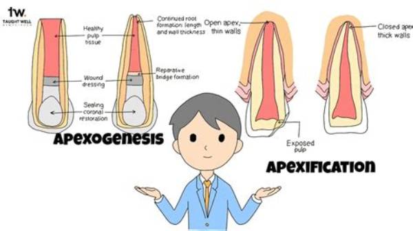 What Is the Difference Between Apexification and Apexogenesis?