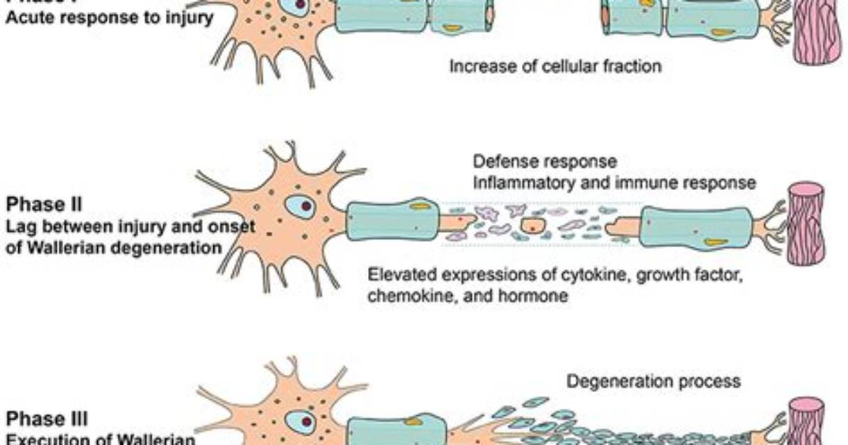 What Is the First Step in Wallerian Degeneration?