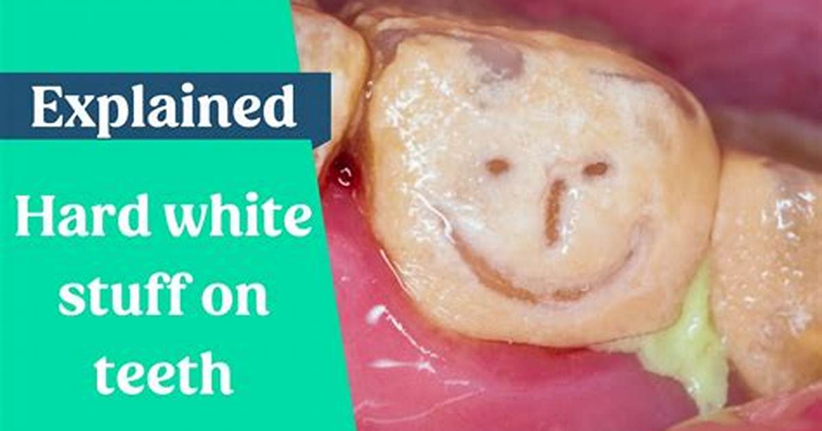 What Is the Hard White Stuff on My Teeth?