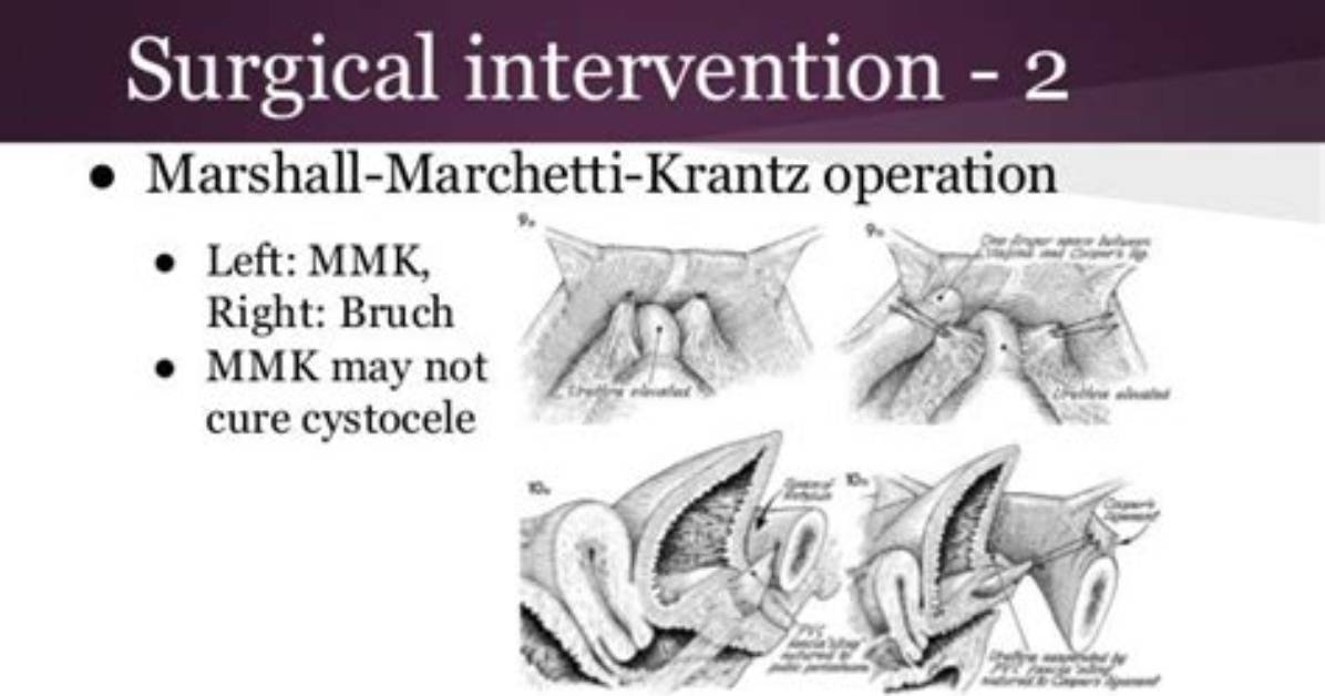 What Is the Marshall-Marchetti-Krantz Procedure?