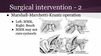 What Is the Marshall-Marchetti-Krantz Procedure?