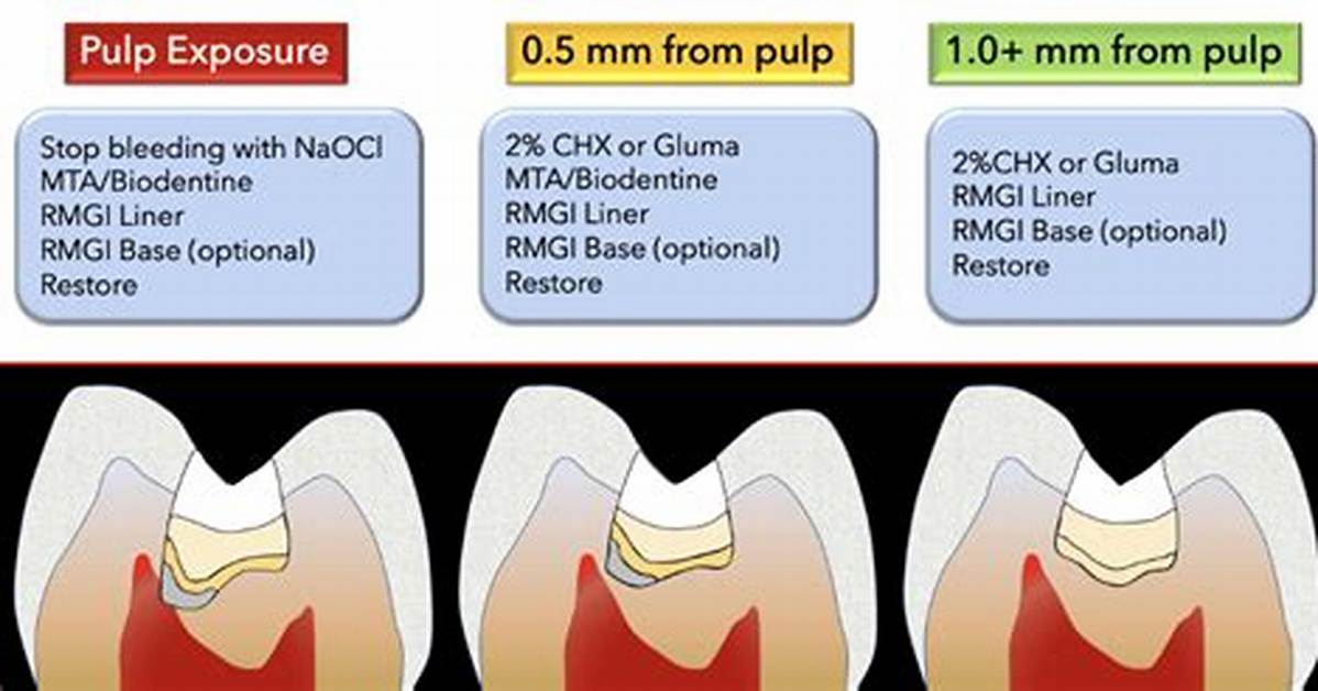 What Is the Procedure for Pulp Capping?