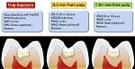 What Is the Procedure for Pulp Capping?
