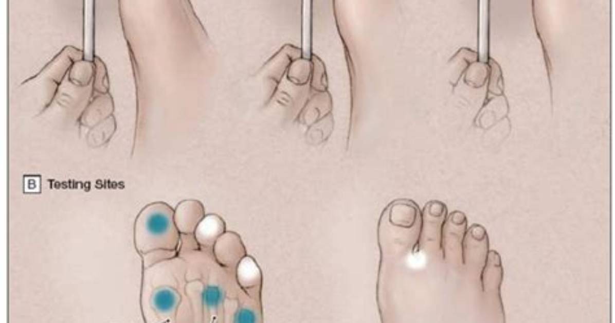 What Is the Test Called for Neuropathy?