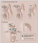 What Is the Test Called for Neuropathy?