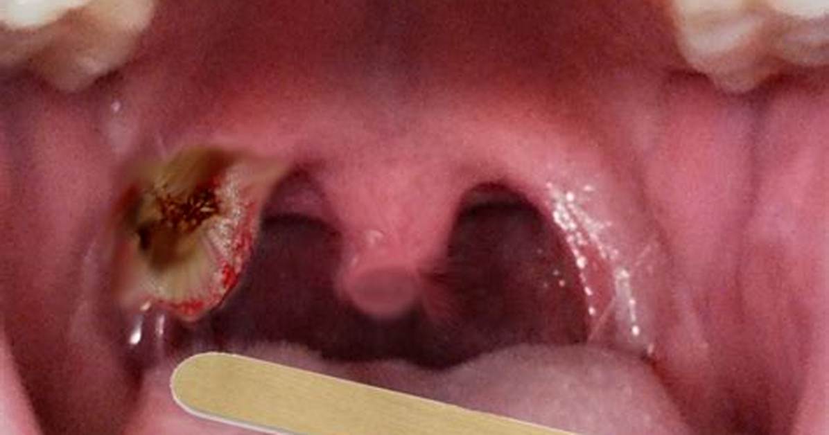 What Is Tonsil Cancer?