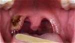 What Is Tonsil Cancer?