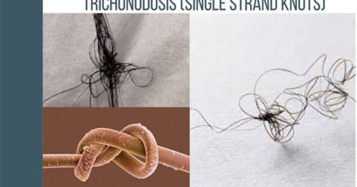 What Is Trichonodosis?